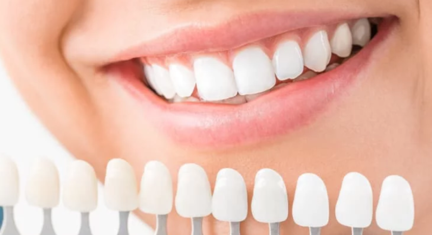 professional teeth whitening